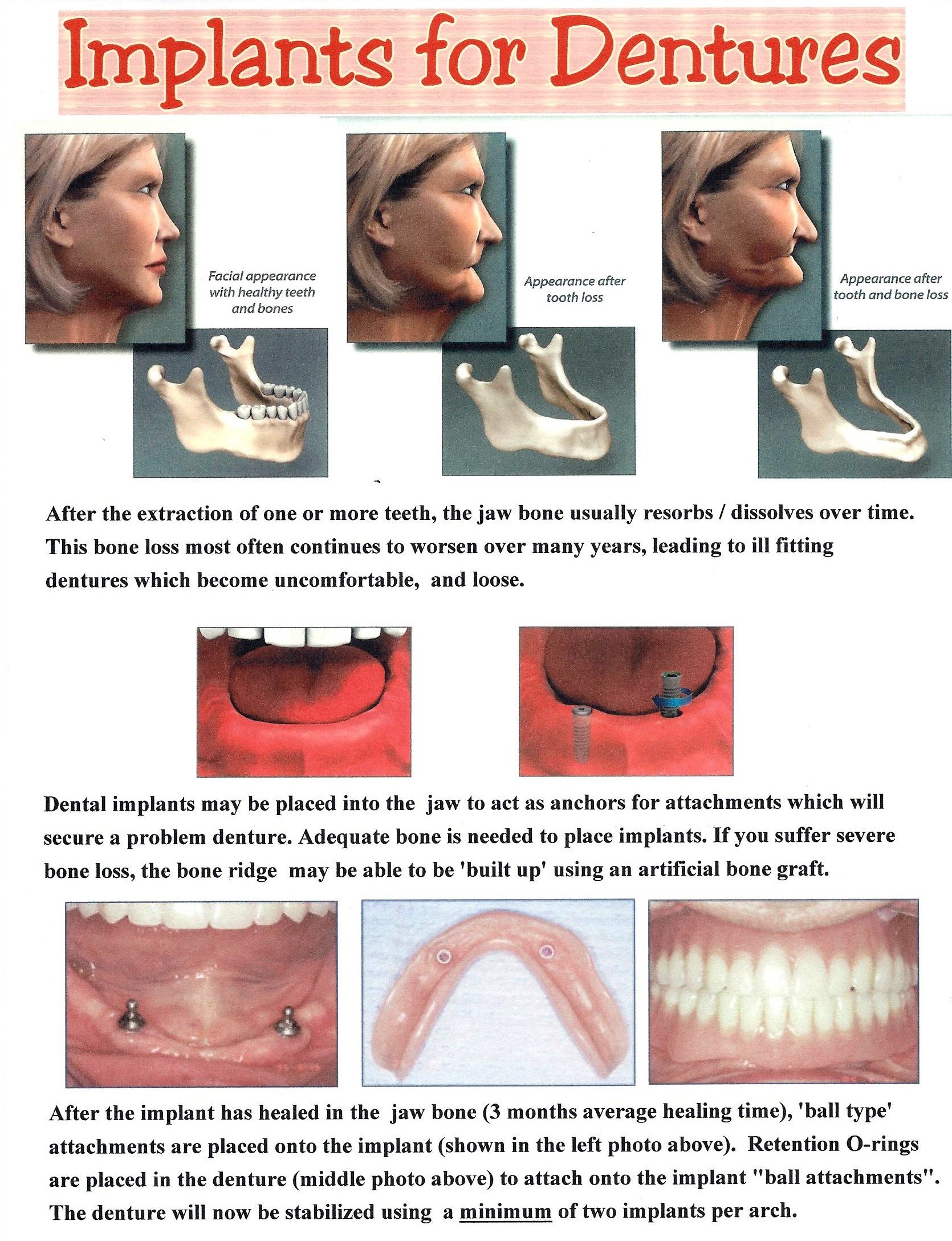 printable denture care fact sheets
